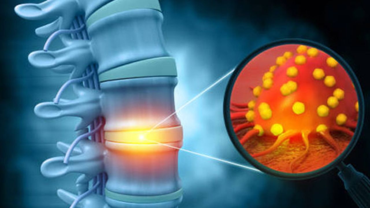 Bone Cancer Awareness Month: अगर है हड्डी कैंसर जागरूकता माह, तो डॉक्टर से जानें हड्डी कैंसर के रिस्क बढ़ाने वाले कारण