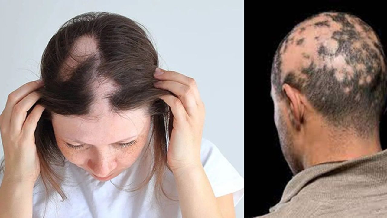 आपके सिर से भी बाल झड़ रहे हैं... क्या आप भी Alopecia के शिकार हैं? जानें लक्षण और बचाव के उपाय