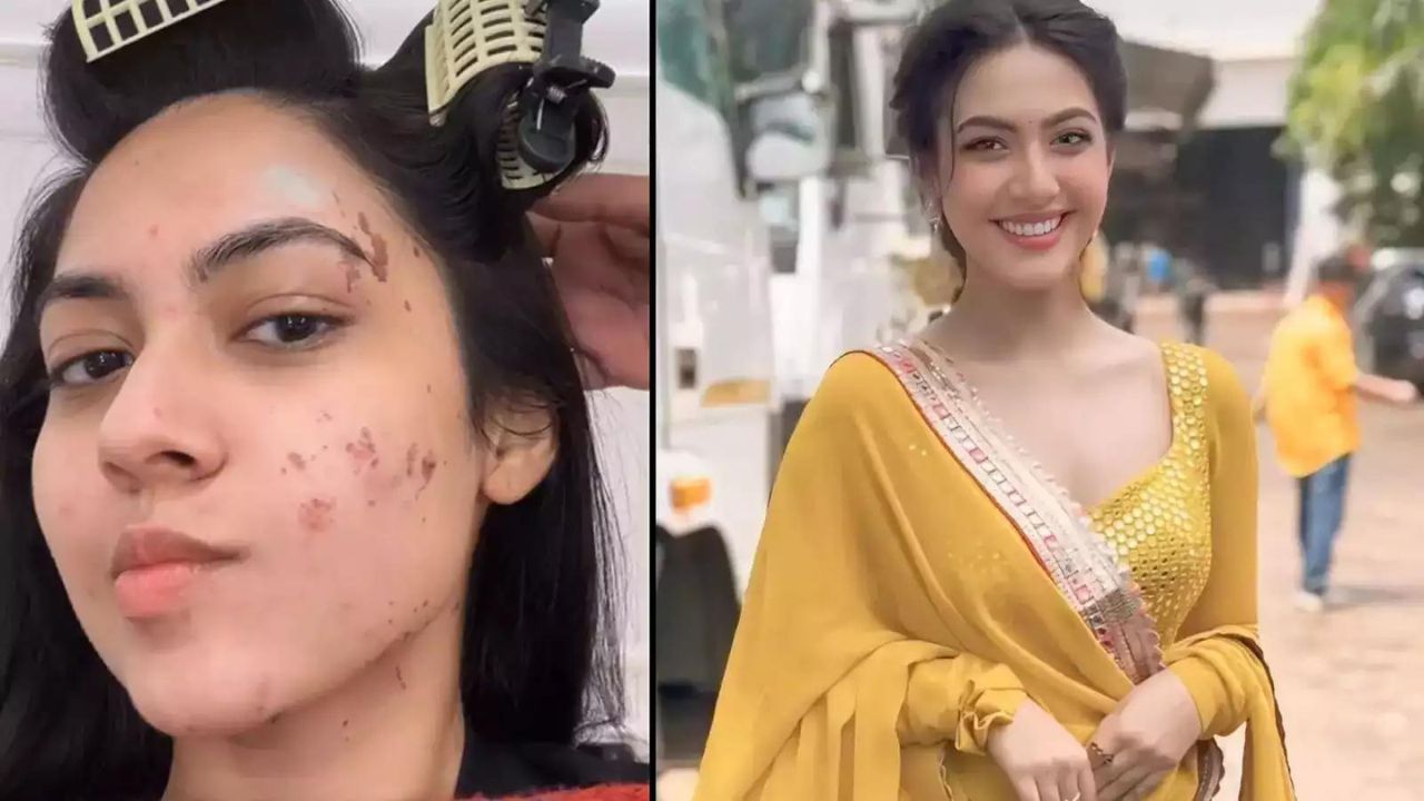 Reem Sheikh का सेट पर हादसा, कुकिंग करते समय चेहरा जलने से दर्द में चीखीं