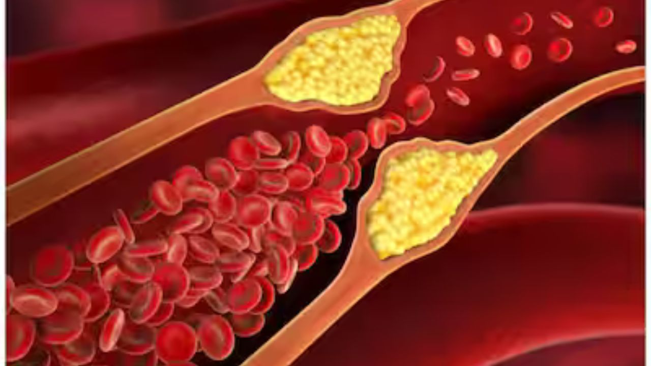 High Cholesterol: रक्त वाहिकाओं में कोलेस्ट्रॉल जमा करने वाले कारक और आपकी गलतियाँ