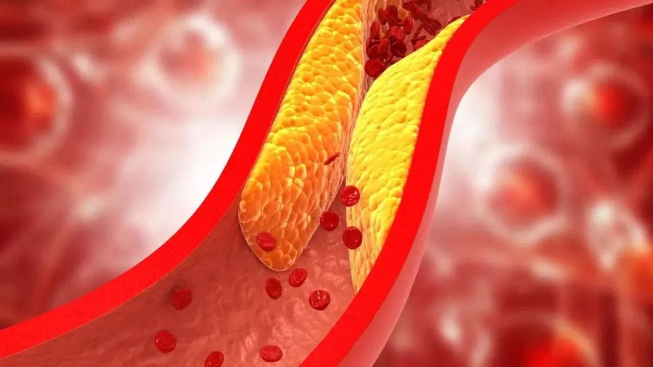 High Cholesterol: रक्त वाहिकाओं में कोलेस्ट्रॉल जमा करने वाले कारक और आपकी गलतियाँ